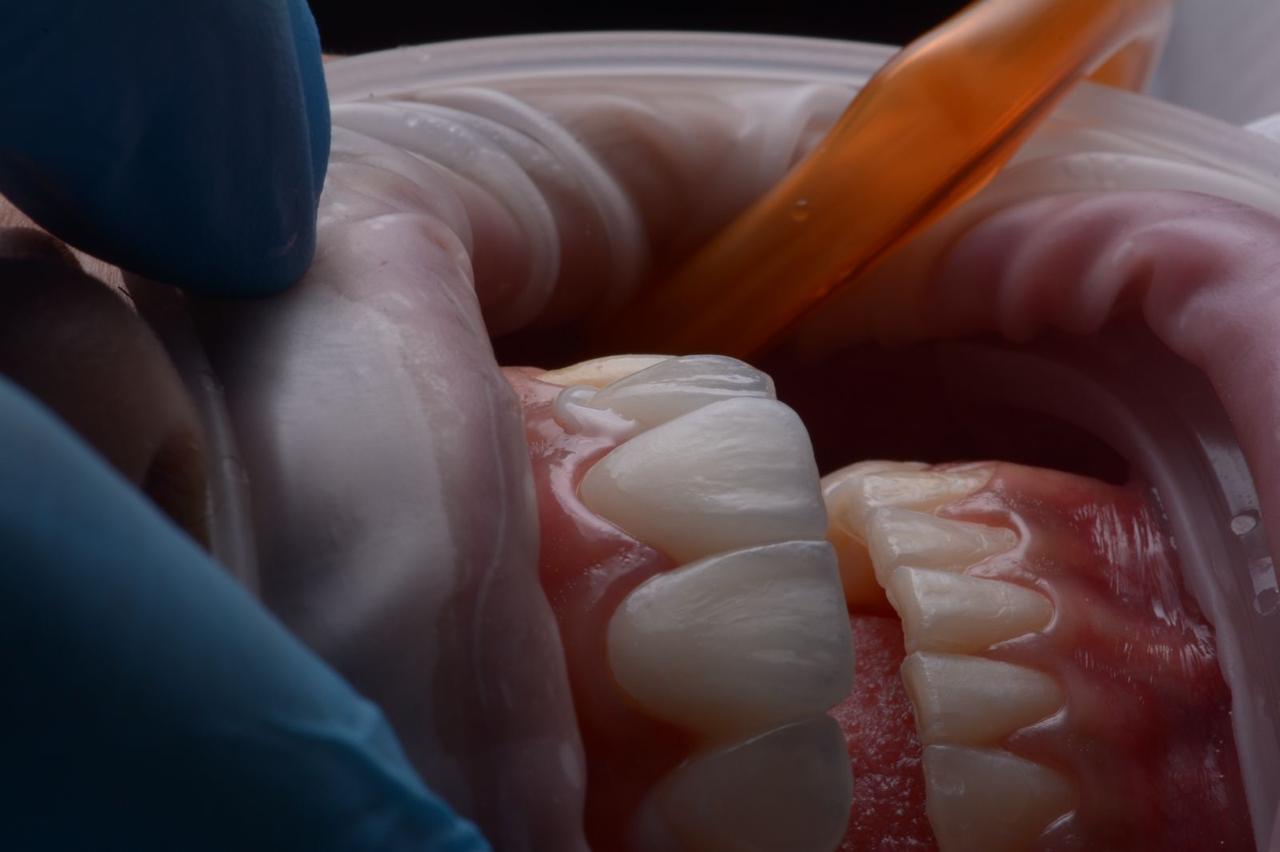 Lentes de contato dental