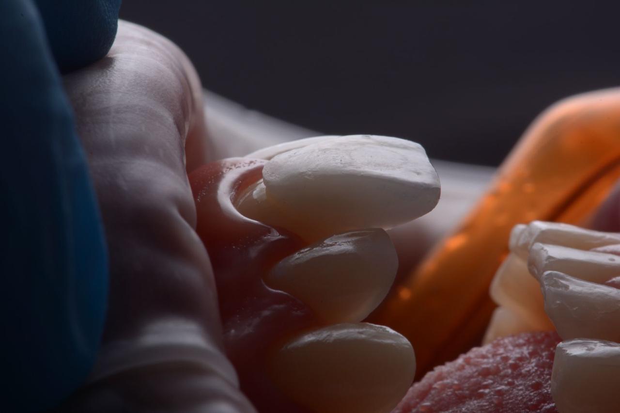 Lentes de contato dental