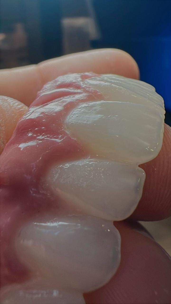 Prótese dentária de alta precisão